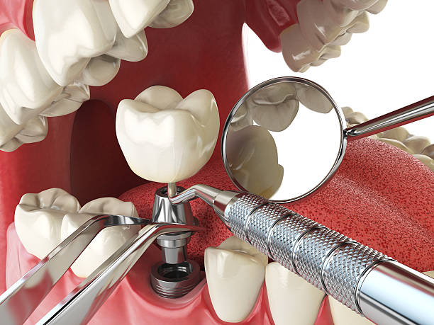 Best Broken or Cracked Tooth Emergency Dentist in Honeoye Falls, NY